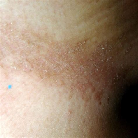 Candidiasis Dermatologo Net