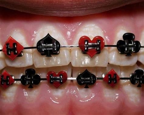 20 best Braces Colors images on Pinterest | Braces colors, Braces tips and Dental braces