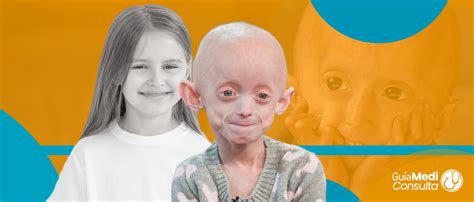 S Ndrome De Hutchinson Gilford Progeria Gu A Mediconsulta