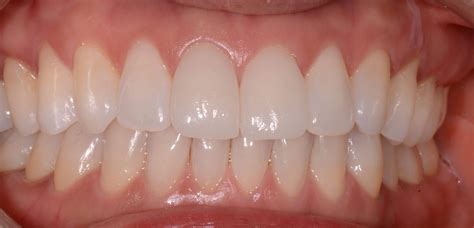 Dental Veneers Same Day Treatment In Sunnyvale