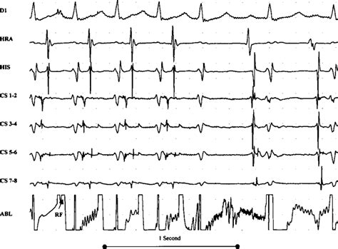 Supraventricular Tachycardia Termination During The Radiofrequency Rf Download Scientific