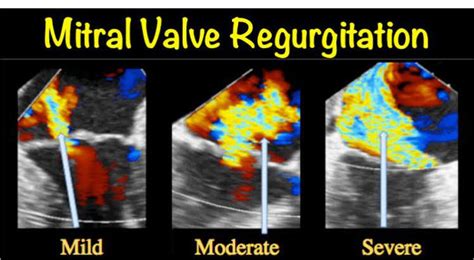 Mitral Valve Regurgitation Causes Medizzy