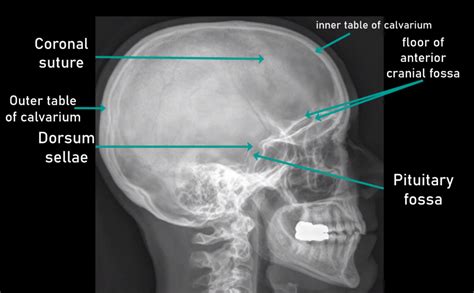 Lateral Skull X-ray Guide: Radiologist's Handbook - HSIN FILM