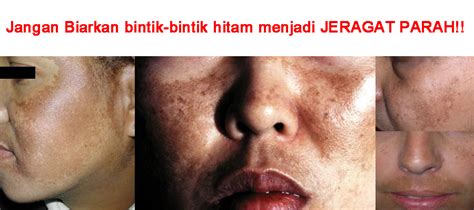 Cara Menghilangkan Jeragat Cara Hilangkan Jeragat