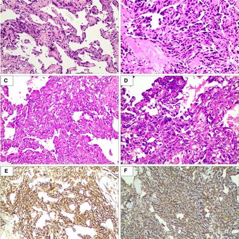 Biopsy Of Right Breast Lesion Microphotography The Tumor Is Composed Download Scientific