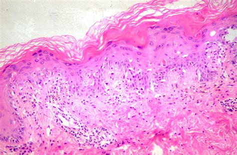 Cutaneous Graft Versus Host Disease Graft Versus Host Disease