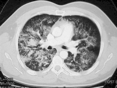 Noncardiogenic Pulmonary Edema