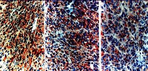 Positive Immunohistochemical Staining For S 100 Protein Vimentin And