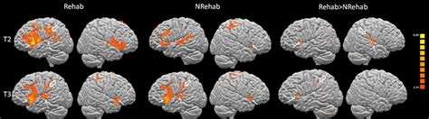 Early Aphasia Rehabilitation Is Associated With Functional Reactivation