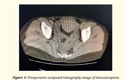 Figure 1 From Heterotopic Pancreas Causing Intussusception In An Adult Patient Semantic Scholar