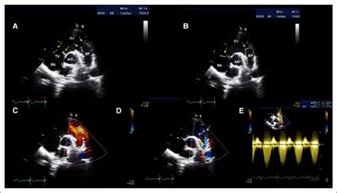 Transthoracic echocardiography (TTE) the day after the percutaneous ...