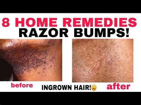 How To Heal A Ingrown Hair - Swimmingkey13