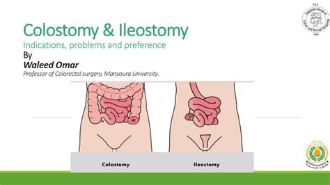 Colostomy And Ileostomy Ppt