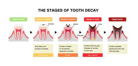 5 Stages Of Tooth Decay