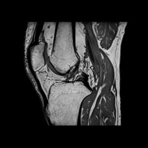 Rezonans Kolana Mridiagnostyka Pl Rezonans Magnetyczny Kolana