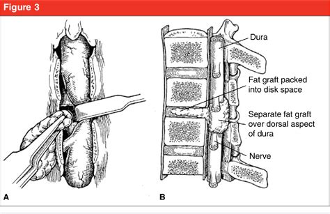 Figure From Dural Tears In Spine Surgery Semantic Scholar