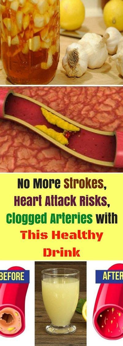 No More Strokes Heart Attack Risks Clogged Arteries With This Healthy