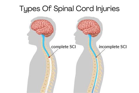 Spinal Cord Injuries Types Complete Vs Incomplete