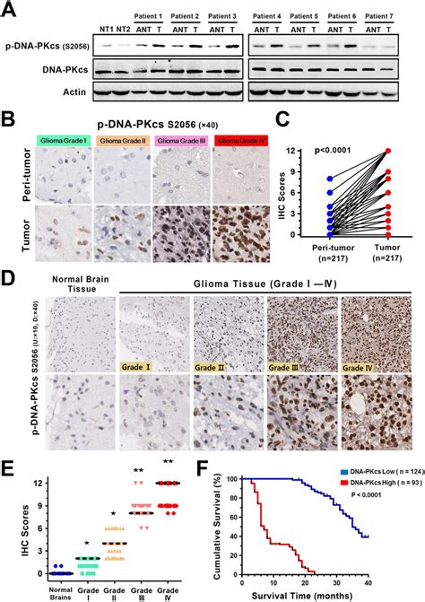 P Dna Pkcs Expression Associates With Tumor Progression And Poor