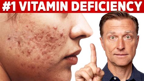 The Top Vitamin Deficiency With Acne YouTube