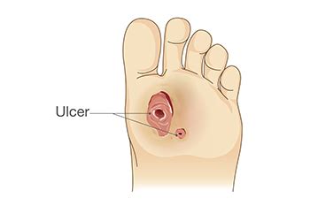 Effective Solutions for Non-Diabetic Foot Ulcers Explained