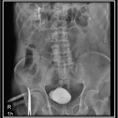 Intravenous Pyelography Ivp 30 Minutes After Instilling The