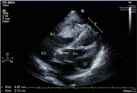 Figure 1 From Oral Squamous Cell Carcinoma Metastasizing To The Heart A Case Report From Taiwan