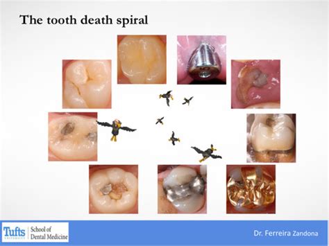 57 Intro To Dental Caries Flashcards Quizlet