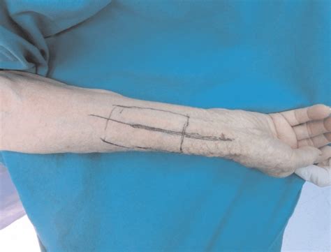 Planning of radial forearm flap by determining the projection of the ...