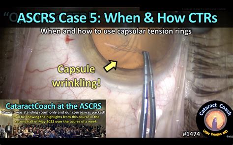 1474 Ascrs Case 5 Ctrs Cataract Coach™