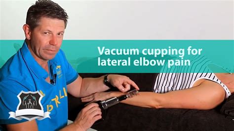 Vacuum Cupping For Lateral Elbow Pain Youtube