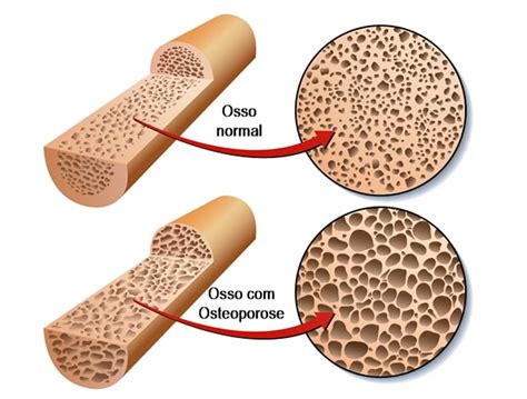 Osteoporose Causas Sintomas E Tratamentos