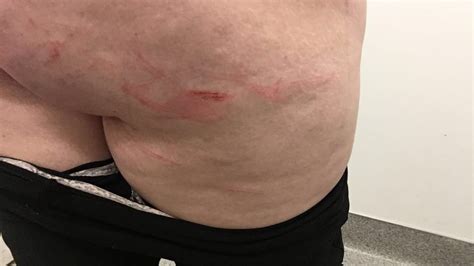 Marks And Bruises Porn Pictures Xxx Photos Sex Images Pictoa