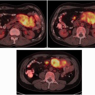 Positron emission tomography and computed tomography scan showing a ...