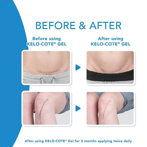 Buy Kelo Cote Scar Treatment Gel G Online At Chemist Warehouse