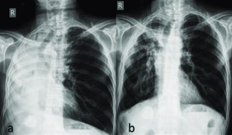 Chest X-ray showing the total atelectasis of the left lung (a), the... | Download Scientific Diagram