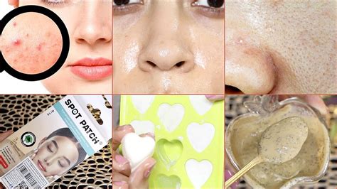 6 Everyday Hacks For Oily Skin Simple And Useful Tips And Trick To Stop