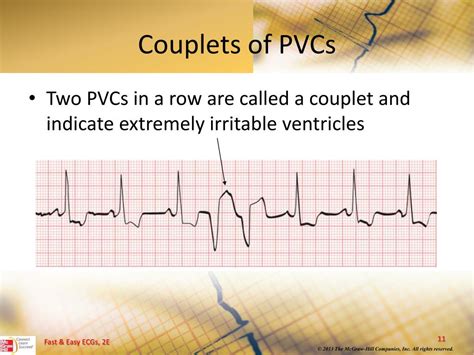 Ppt Ventricular Dysrhythmias Powerpoint Presentation Free Download