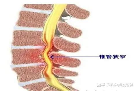 腰椎管狭窄患者如何保养？日常牢记这几点 知乎