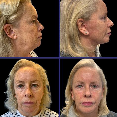 London Plastic Surgeon Stem Cell Facelift Surgery