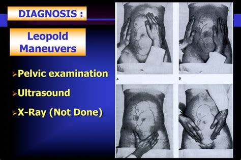 Breech Obstetrics Ppt