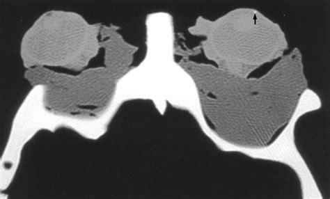 Radiologic Differentiation Of Intraocular Glass Evaluation Of Imaging Techniques Glass Types