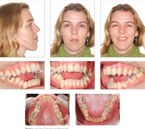 Figure From Open Bite In Adult Patients Semantic Scholar