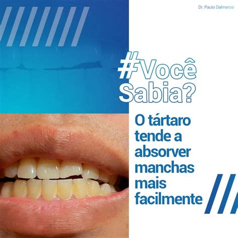 Voc Sabia Que O T Rtaro Tende A Absorver As Manchas Mais