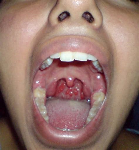 Chronic Granular Pharyngitis Laser Treatment In Trivandrum Kerala Dr