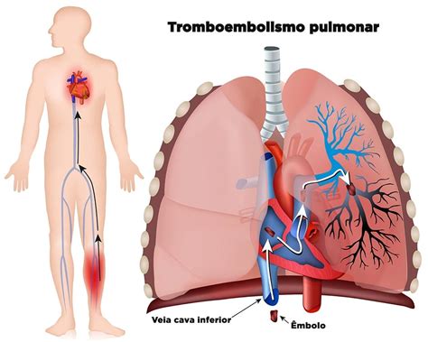 Recomeçar EMBOLIA PULMONAR