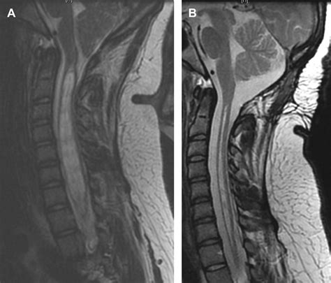 Imaging In Chiari I Malformation Neurosurgery Clinics