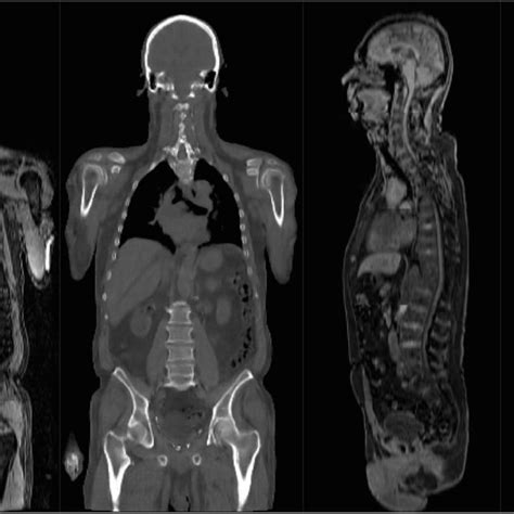 A Synthetic Whole Body Ct Volume Generated From Patient Dixon Mr Data