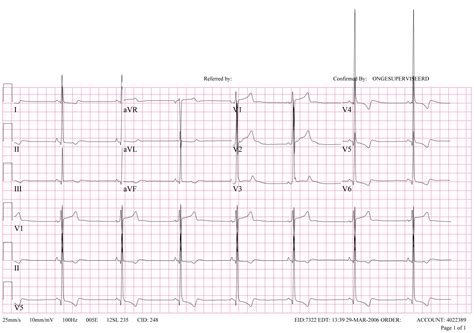 Electrocardiographic findings in left ventricular hypertrophy - wikidoc