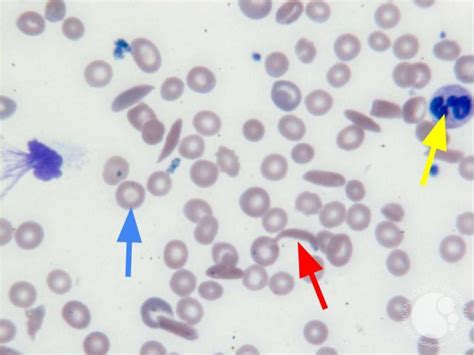 Sickle Cell Anemia